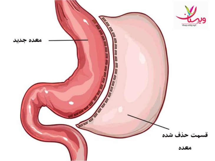 پوشش بیمه تکمیلی جراحی اسلیو معده در شرکتهای مختلف