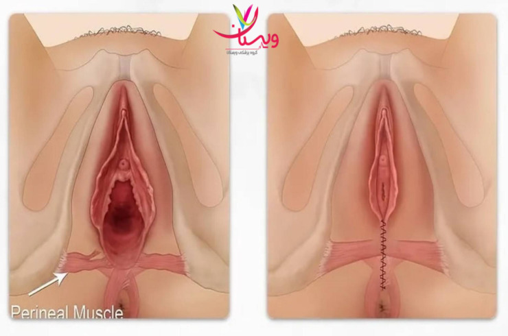 هزینه دقیق واژینوپلاستی چگونه تعیین می‌شود؟