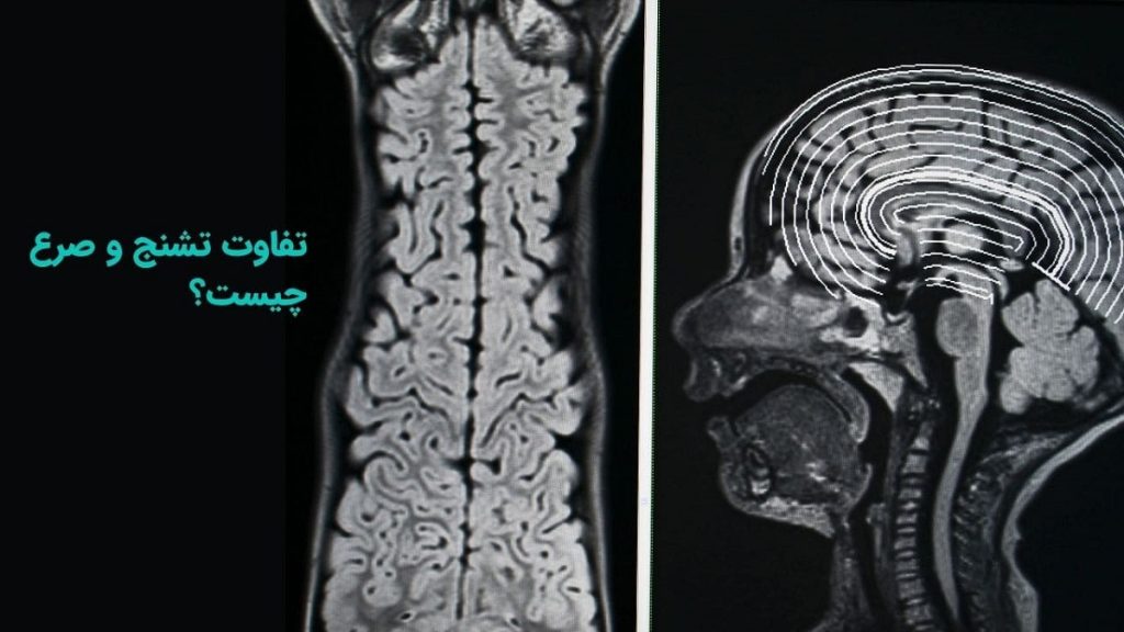 فرق صرع و تشنج چیست