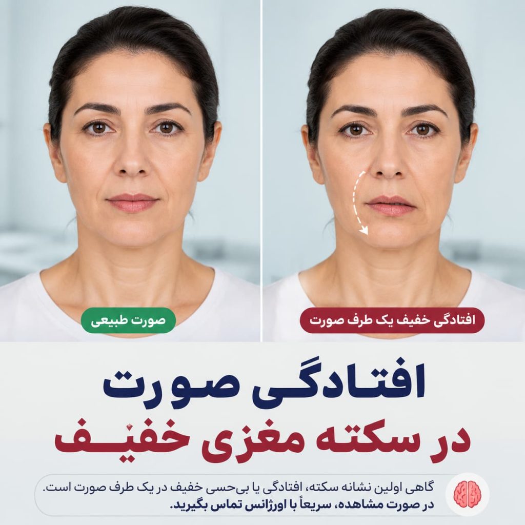 علایم-سکته-خفیف-مغزی
